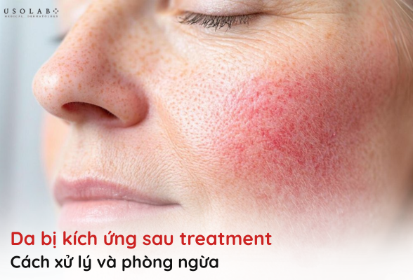 da kích ứng sau treatment