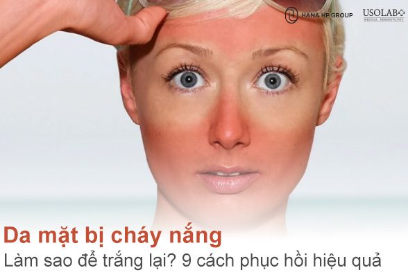 Da mặt bị cháy nắng làm sao để trắng lại