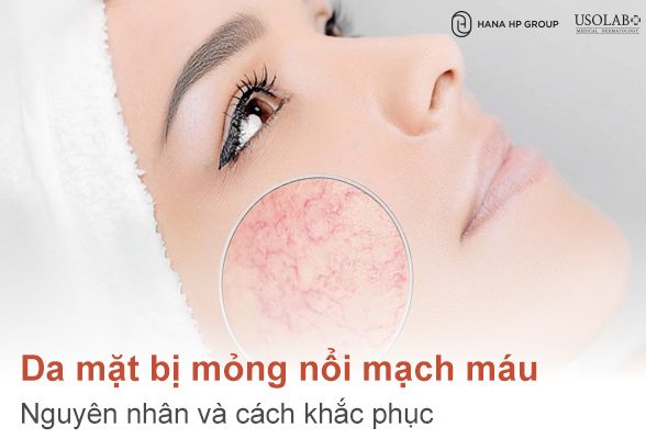 Da mặt bị mỏng nổi mạch máu