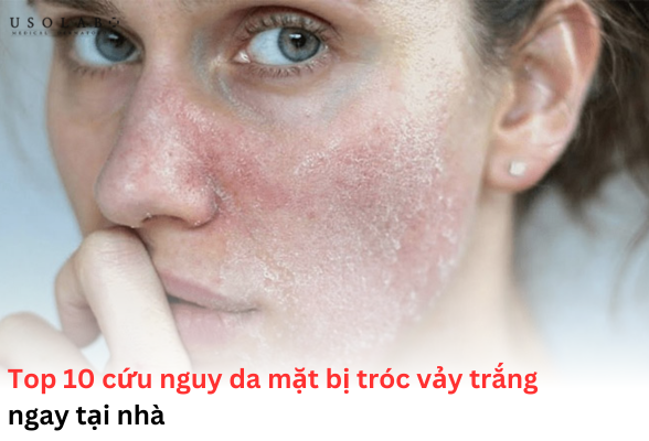 da mặt bị tróc vảy trắng