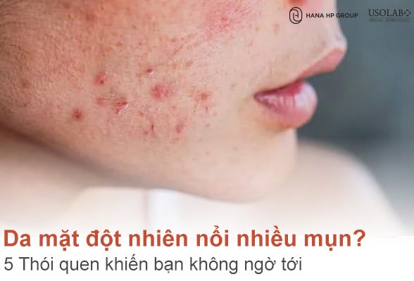 Vì sao da mặt đột nhiên nổi nhiều mụn? 5 Thói quen khiến bạn không ngờ tới