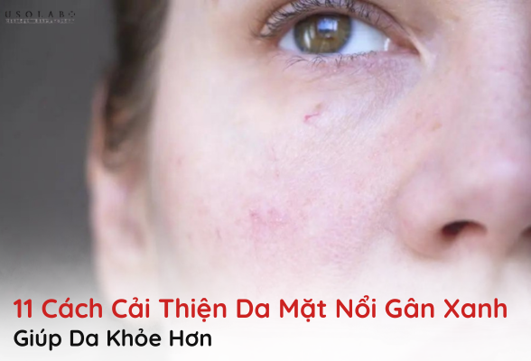 da mặt nổi gân xanh