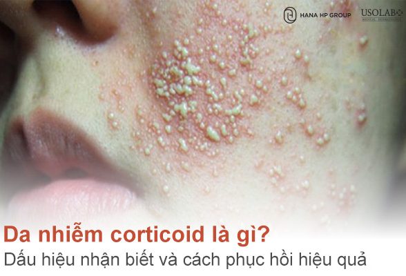 Da nhiễm corticoid là gì? Dấu hiệu nhận biết và cách phục hồi hiệu quả