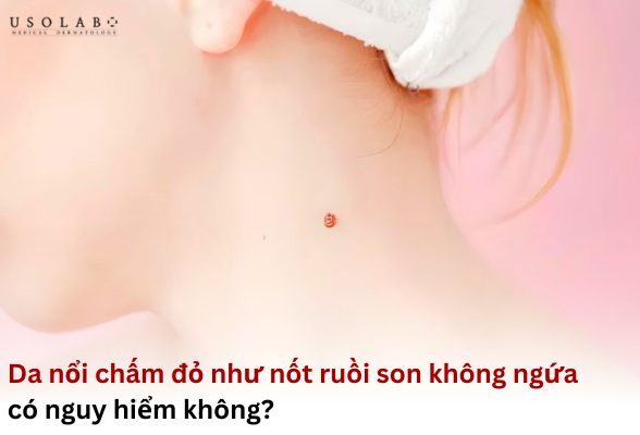 da nổi chấm đỏ như nốt ruồi son không ngứa