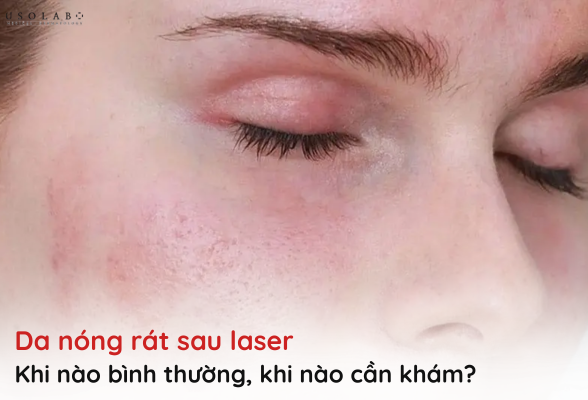 da nóng rát sau laser