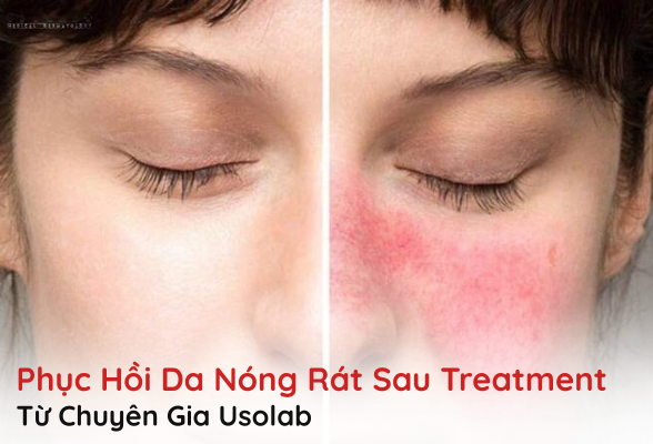 phục hồi da nóng rát sau treatment