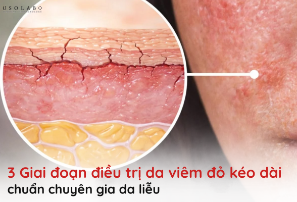 da viêm đỏ kéo dài