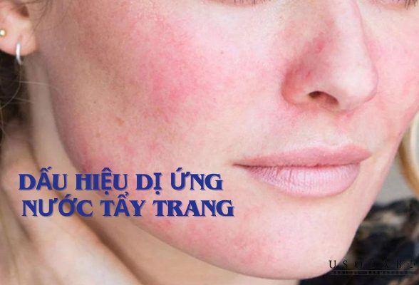 dấu hiệu dị ứng nước tẩy trang