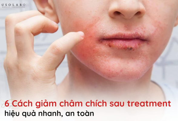 giảm châm chích sau treatment