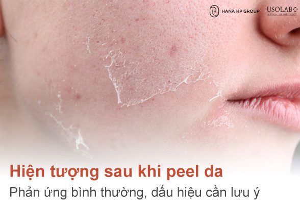Hiện tượng sau khi peel da: Phản ứng bình thường, dấu hiệu cần lưu ý