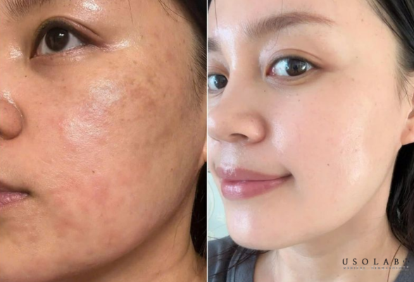kem phục hồi sau meso