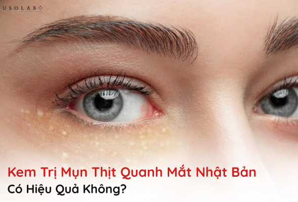 kem trị mụn thịt quanh mắt nhật bản