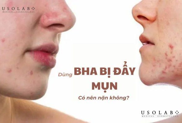 Khi dùng BHA bị đẩy mụn có nên nặn