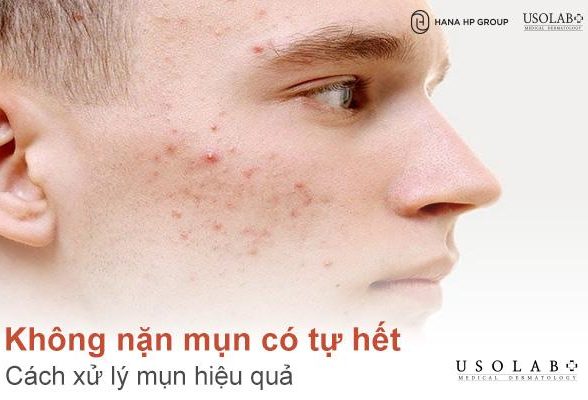 [Giải đáp] Không nặn mụn có tự hết không? Cách xử lý mụn hiệu quả không cần nặn