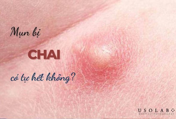 mụn bị chai có tự hết không