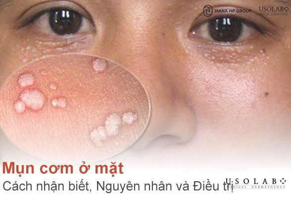 Mụn cơm ở mặt - Cách Nhận biết, Nguyên nhân và Điều trị hiệu quả