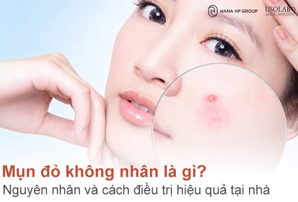 Mụn đỏ không nhân là gì? Nguyên nhân và cách điều trị hiệu quả tại nhà