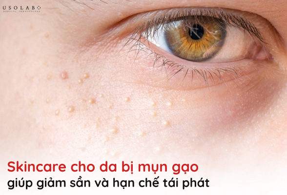 MỤN GẠO