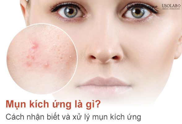 Mụn kích ứng là gì? Cách nhận biết và xử lý mụn kích ứng an toàn tại nhà