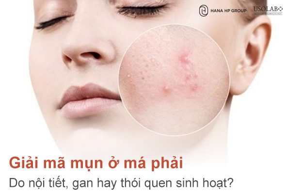 Mụn ở má phải