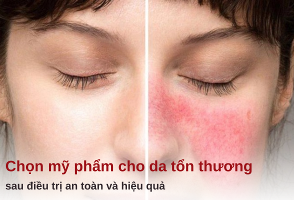 mỹ phẩm cho da tổn thương sau điều trị