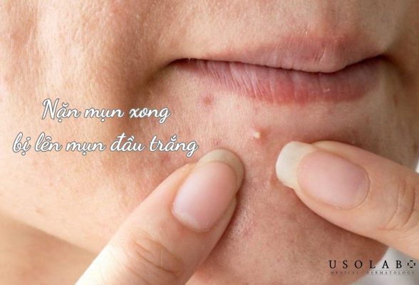 nặn mụn xong bị lên mụn đầu trắng