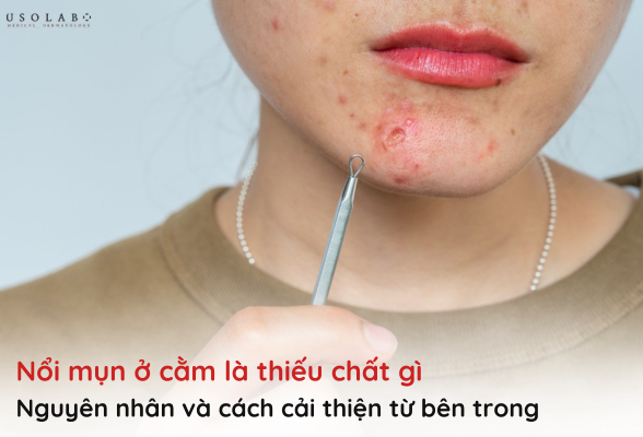 nổi mụn ở cằm là thiếu chất gì
