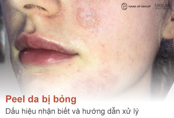 Peel da bị bỏng: Dấu hiệu nhận biết và hướng dẫn xử lý