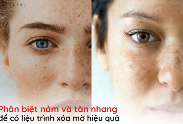 phân biệt nám và tàn nhang