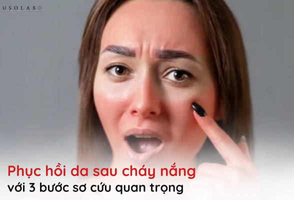 phục hồi da sau cháy nắng