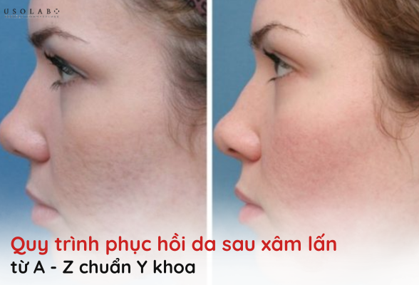 phục hồi da sau xâm lấn