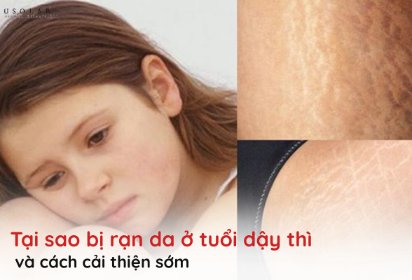 tại sao bị rạn da ở tuổi dậy thì