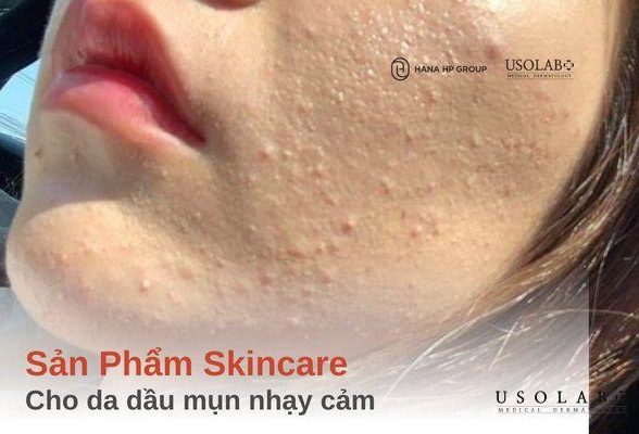 Top 4 sản phẩm skincare cho da dầu mụn nhạy cảm chuyên gia khuyên dùng