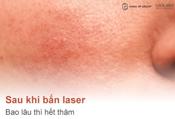 Sau khi bắn laser bao lâu thì hết thâm? Giải đáp từ chuyên gia da liễu