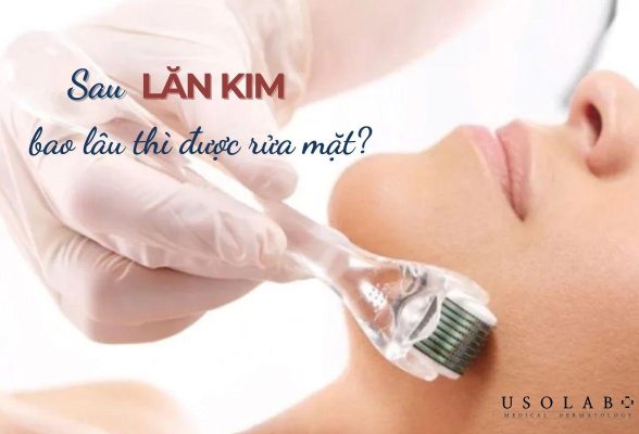 sau lăn kim bao lâu thì được rửa mặt