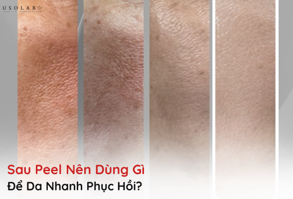 sau peel nên dùng gì
