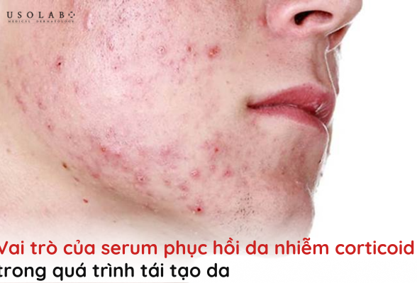serum phục hồi da nhiễm corticoid