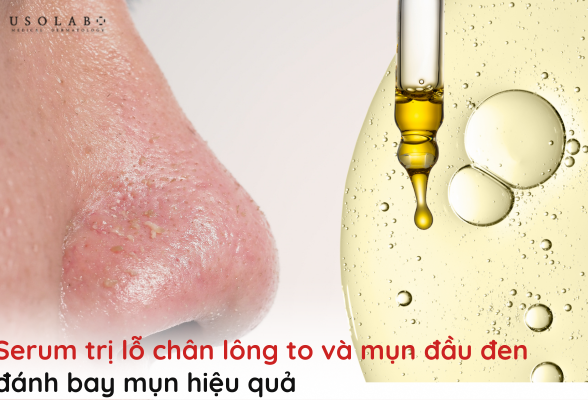 serum trị lỗ chân lông to và mụn đầu đen