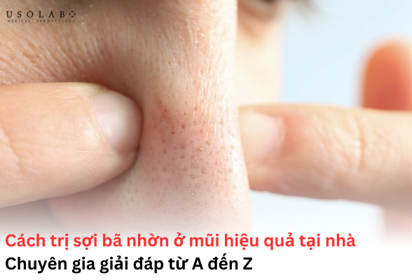 sợi bã nhờn ở mũi