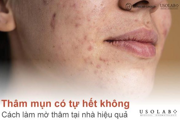 Thâm mụn có tự hết không? Cách làm mờ thâm tại nhà hiệu quả