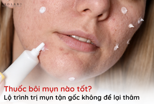 thuốc bôi mụn