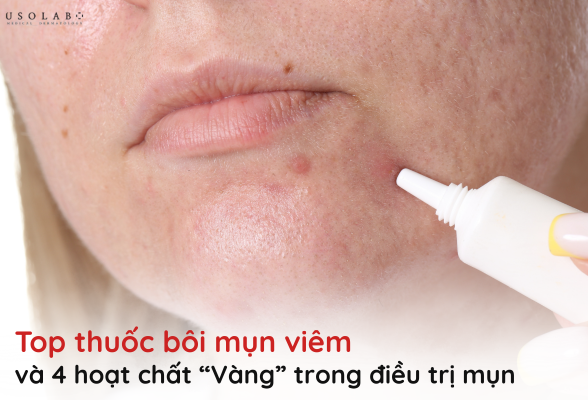 thuốc bôi mụn viêm