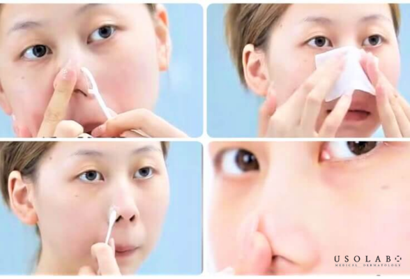 tinh chất đường đen trị mụn