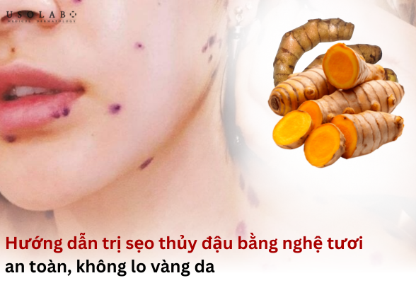 tri-seo-thuy-dau-bang-nghe-tuoi trị sẹo thủy đậu bằng nghệ tươi
