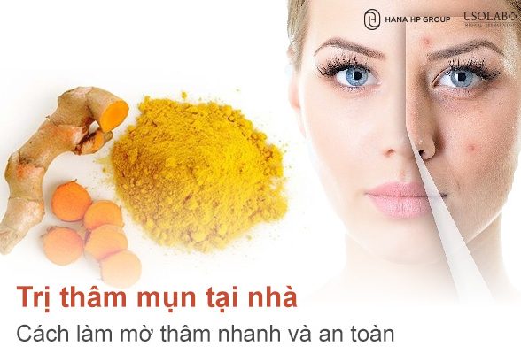 Trị thâm mụn tại nhà - Cách làm mờ thâm nhanh và an toàn