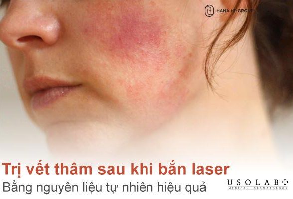 Cách trị vết thâm sau khi bắn laser bằng nguyên liệu tự nhiên hiệu quả