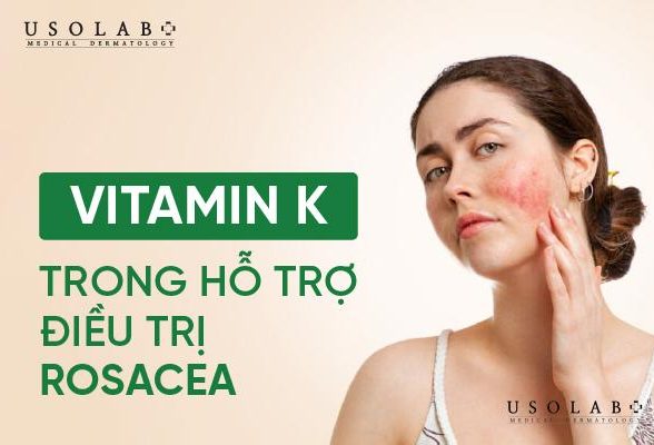 Vitamin K trong Hỗ Trợ Điều Trị Rosacea (Chứng Đỏ Mặt)