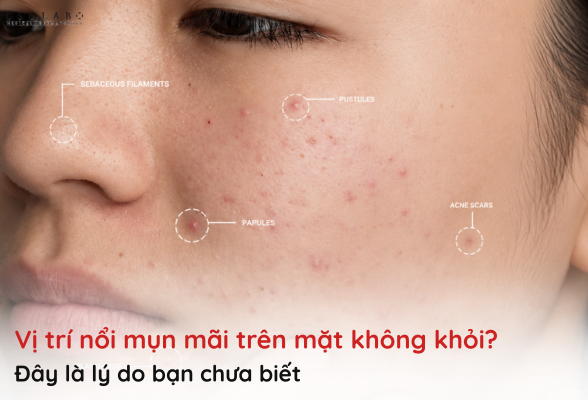 vị trí nổi mụn