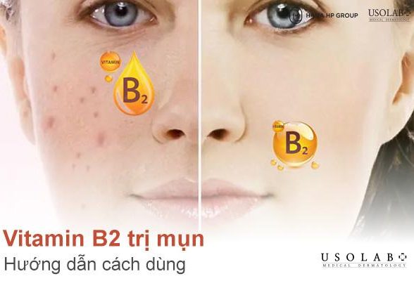 Dùng vitamin B2 trị mụn được không? Hướng dẫn cách dùng