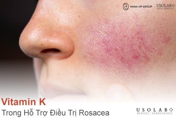 Vitamin K trong Hỗ Trợ Điều Trị Rosacea (Chứng Đỏ Mặt)